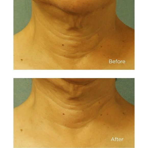 Perricone MD Cold Plasma Plus+ Neck & Chest Broad Spectrum SPF 25 - Picture 4 of 4